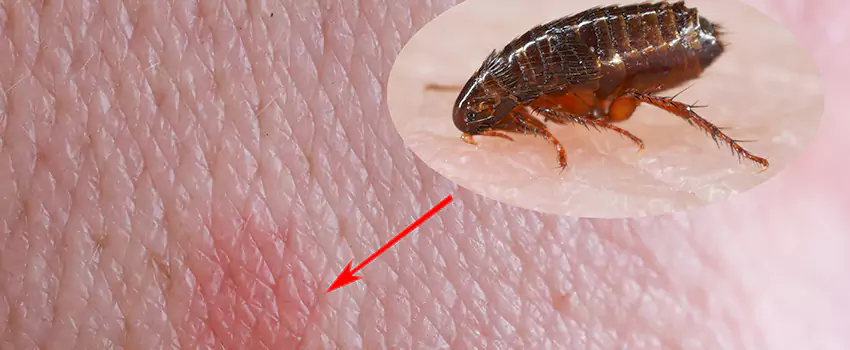 Flea Control for Humans Anaheim, CA